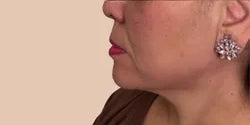 8 Point Lift with Filler