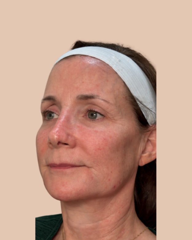 8 Point Lift (Filler)