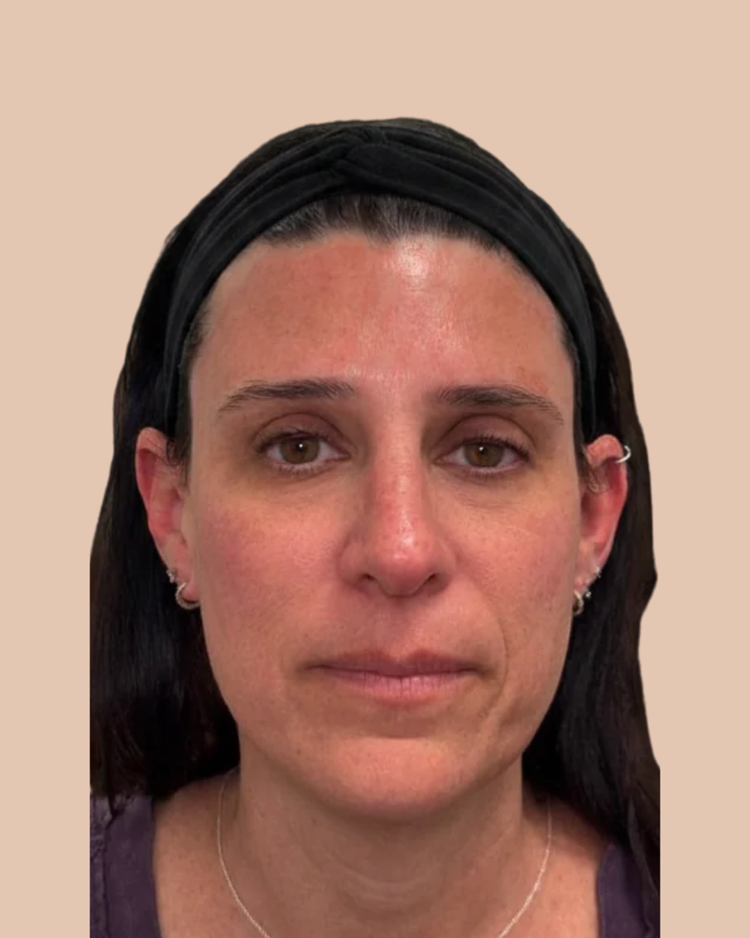 EZ Gel & Botox