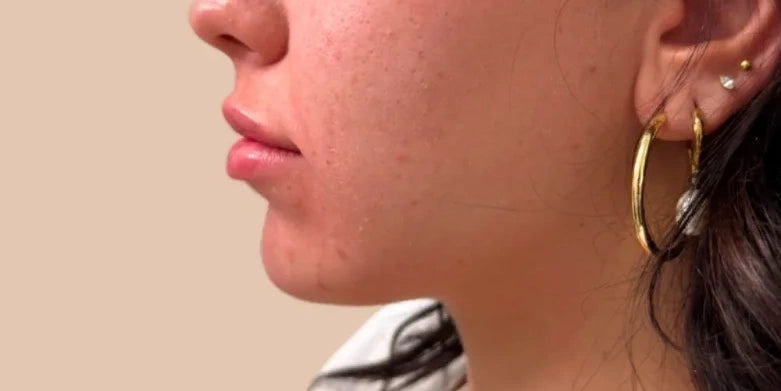 Chin Filler