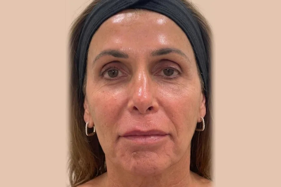 Sculptra