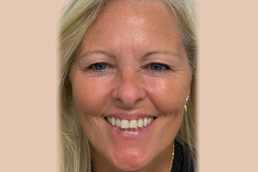 VI Peel & Botox
